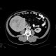 Renal cell carcinoma: CT - Computed tomography