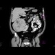 Renal cell carcinoma: CT - Computed tomography