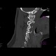 Fracture of occipital condyle: CT - Computed tomography