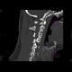 Fracture of occipital condyle: CT - Computed tomography