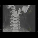 Fracture of occipital condyle: CT - Computed tomography