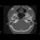 Osteoma of external auditory meatus: CT - Computed tomography