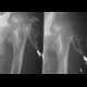 Hip replacement, osteomyelitis, fistula of hip joint: X-ray - Plain radiograph
