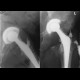 Hip replacement, osteomyelitis, fistula of hip joint: X-ray - Plain radiograph