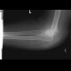 Pseudoarthrosis of humerus, supracondylic fracture: X-ray - Plain radiograph