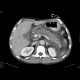 Acute pancreatitis, exsudative stage: CT - Computed tomography