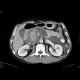 Acute pancreatitis, exsudative stage: CT - Computed tomography