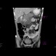 Acute pancreatitis, exsudative stage: CT - Computed tomography