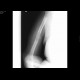 Pathological fracture of humerus: X-ray - Plain radiograph