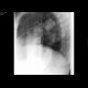 Pathological fracture of humerus: X-ray - Plain radiograph