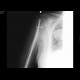 Pathological fracture of humerus: X-ray - Plain radiograph