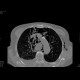 Perforation of oesophagus, pneumomediastinum: CT - Computed tomography