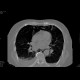 Perforation of oesophagus, pneumomediastinum: CT - Computed tomography
