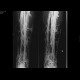 Phlebography: X-ray - Plain radiograph