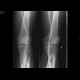 Phlebography: X-ray - Plain radiograph