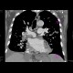 Lung embolism, massive: CT - Computed tomography