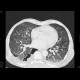 Bullous emphysema: CT - Computed tomography