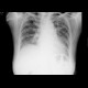 Idiopathic lung fibrosis: X-ray - Plain radiograph