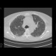 Idiopathic lung fibrosis: CT - Computed tomography