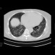 Idiopathic lung fibrosis: CT - Computed tomography