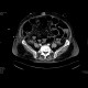 Bowel ischemia, gas in portal vein and liver: CT - Computed tomography