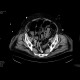 Bowel ischemia, gas in portal vein and liver: CT - Computed tomography