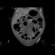Bowel ischemia, gas in portal vein and liver: CT - Computed tomography