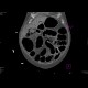 Bowel ischemia, gas in portal vein and liver: CT - Computed tomography
