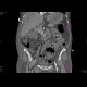 Bowel ischemia, gas in portal vein and liver: CT - Computed tomography