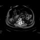 Bowel ischemia, gas in portal vein and liver: CT - Computed tomography