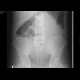 Pneumoperitoneum, massive: X-ray - Plain radiograph