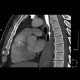 Ectopic pancreas, gigantic, pancreatic ectopia: CT - Computed tomography