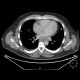 Ectopic pancreas, gigantic, pancreatic ectopia: CT - Computed tomography