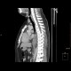 Ectopic pancreas, gigantic, pancreatic ectopia: CT - Computed tomography