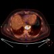 Ectopic pancreas, gigantic, pancreatic ectopia: NM - Nuclear medicine