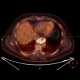 Ectopic pancreas, gigantic, pancreatic ectopia: NM - Nuclear medicine