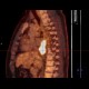 Ectopic pancreas, gigantic, pancreatic ectopia: NM - Nuclear medicine