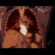 Ectopic pancreas, gigantic, pancreatic ectopia: NM - Nuclear medicine