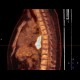 Ectopic pancreas, gigantic, pancreatic ectopia: NM - Nuclear medicine
