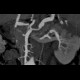 Polyarteritis nodosa: CT - Computed tomography