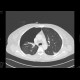 Pneumothorax: CT - Computed tomography