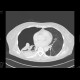 Pneumothorax: CT - Computed tomography