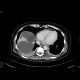 Polycystosis of liver and kidney: CT - Computed tomography