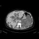 Polycystosis of liver and kidney: CT - Computed tomography