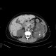 Polycystosis of liver and kidney: CT - Computed tomography