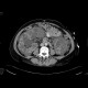 Polycystosis of liver and kidney: CT - Computed tomography