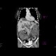 Polycystosis of liver and kidney: CT - Computed tomography