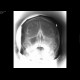 Polyp of maxillary sinus: X-ray - Plain radiograph