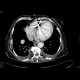 Renal cell carcinoma, recurrence, metastases: CT - Computed tomography