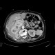 Renal cell carcinoma, recurrence, metastases: CT - Computed tomography